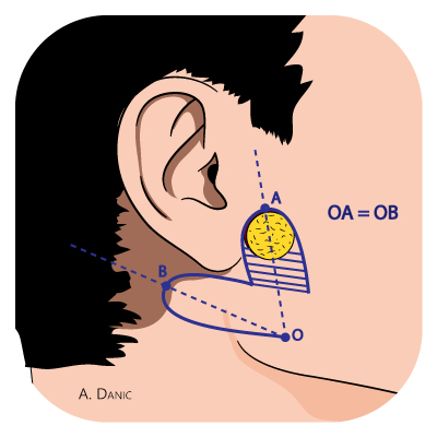 lambeau-de-transposition-r-tro-auriculaire-lambeauclic